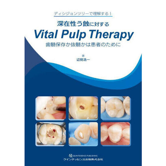 深在性う蝕に対するＶｉｔａｌ　Ｐｕｌｐ　Ｔｈｅｒａｐｙ　歯髄保存か抜髄かは患者のために　ディシジョンツリーで理解する！