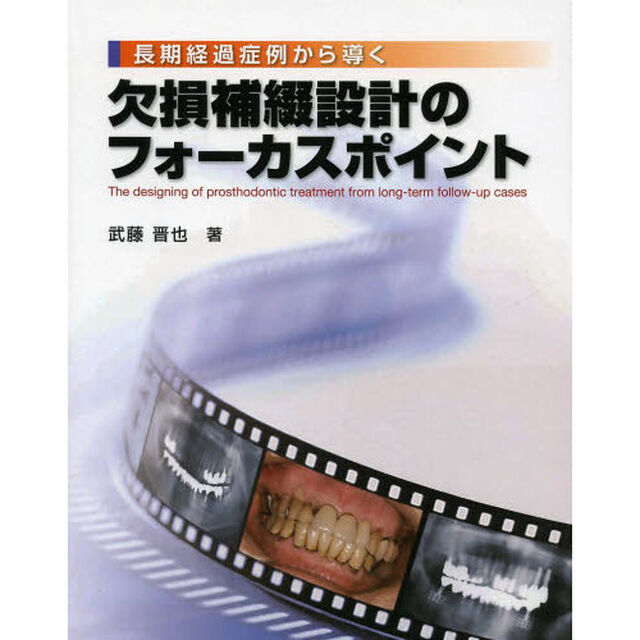 長期経過症例から導く欠損補綴設計のフォーカスポイント