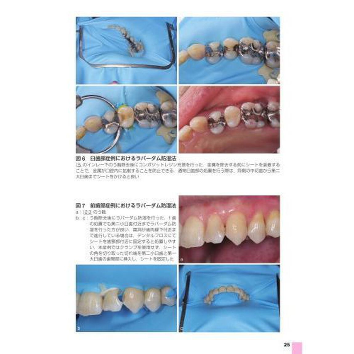 う蝕処置　卒後５年を支えるスタートガイド