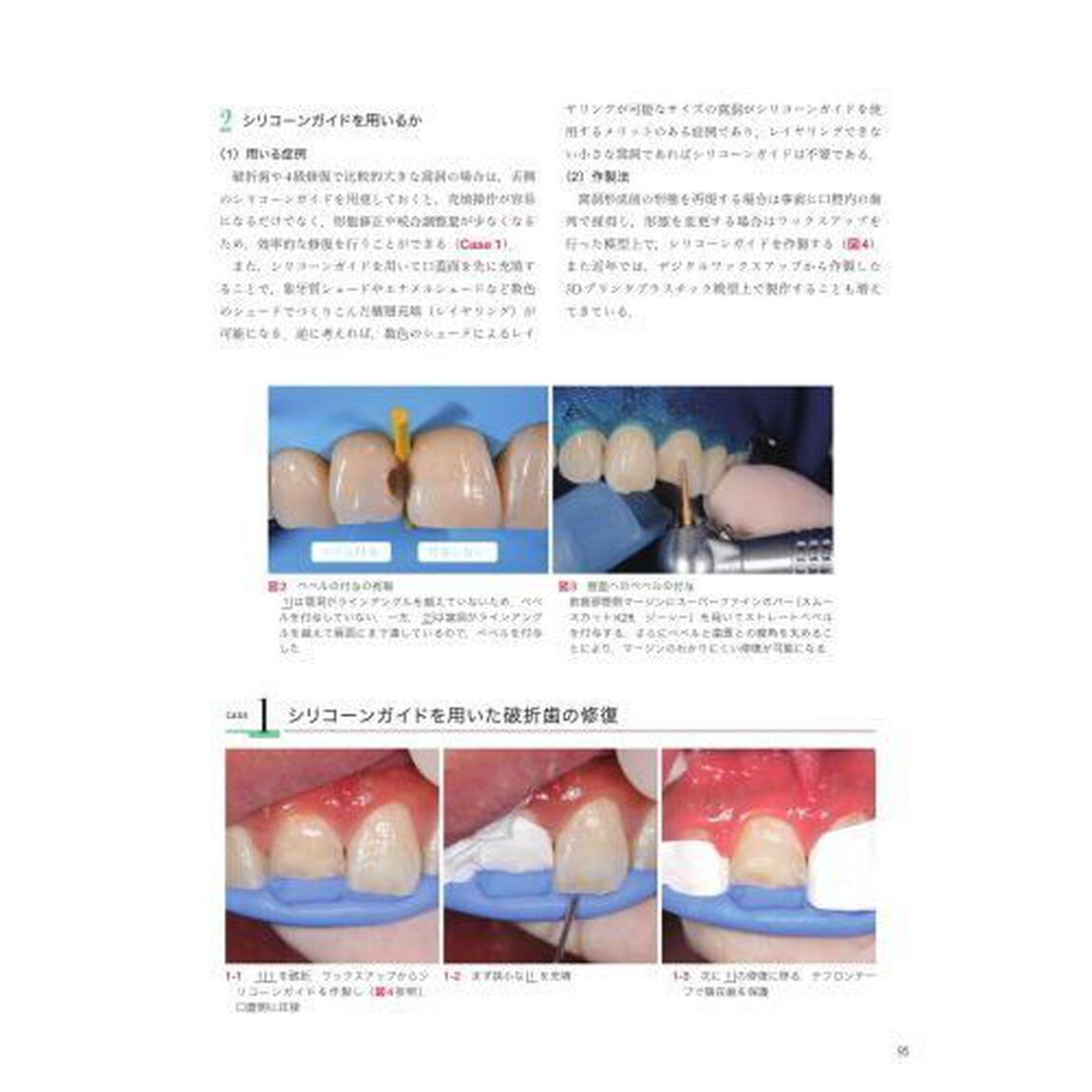 手に取るようにわかるコンポジットレジン修復のメソッド