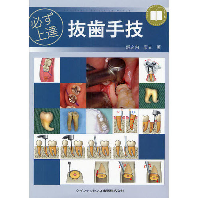 必ず上達抜歯手技
