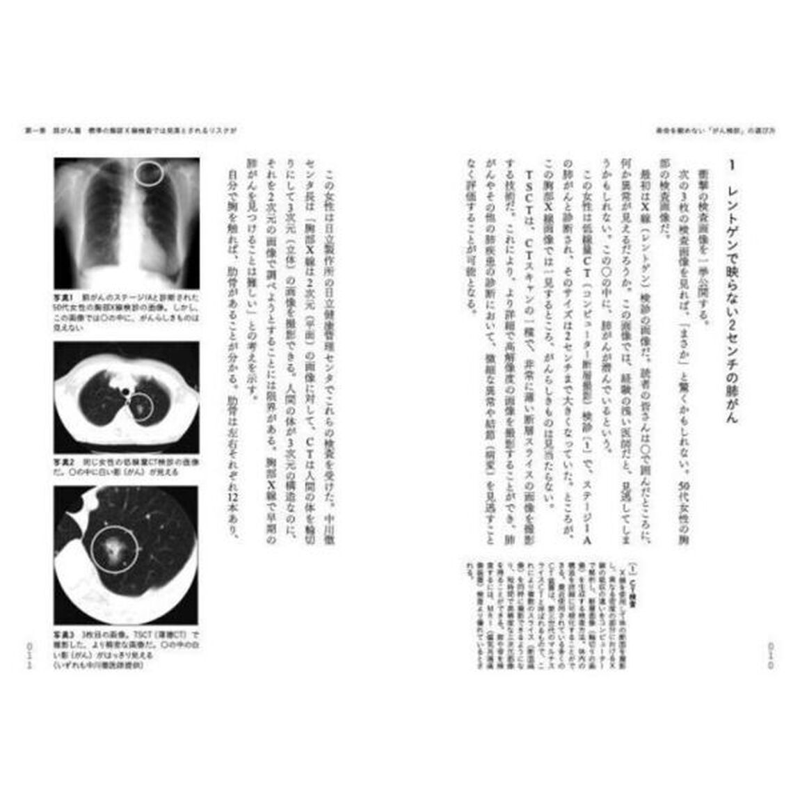 寿命を縮めない「がん検診」の選び方　肺がん・乳がん・食道がんの発見が遅れないために