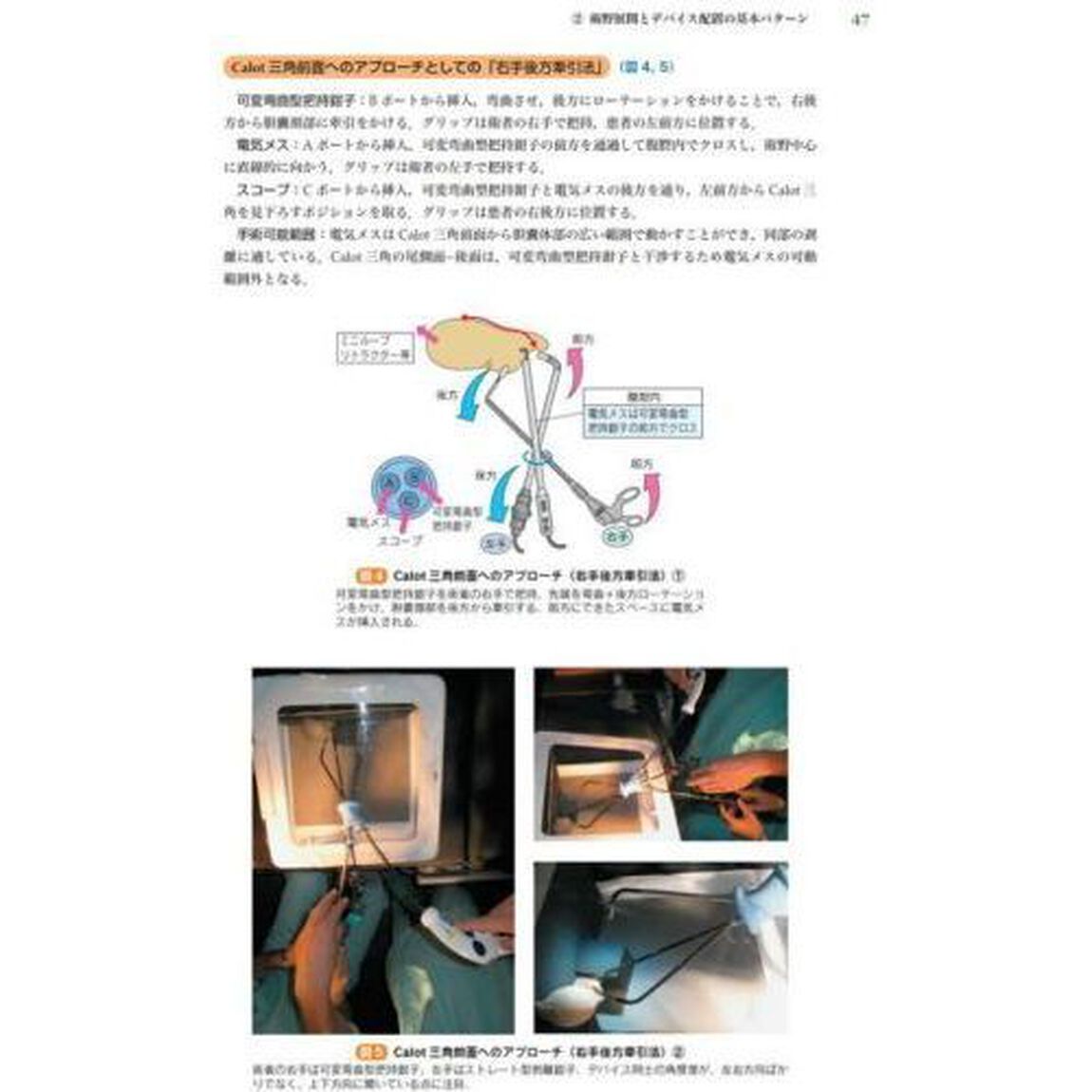 単孔式内視鏡手術　基本テクニックとその応用