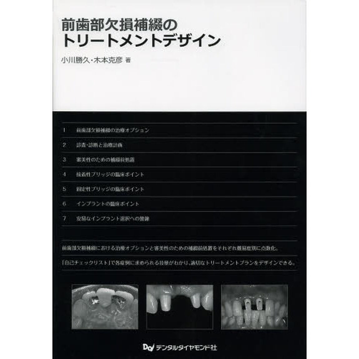 前歯部欠損補綴のトリートメントデザイン