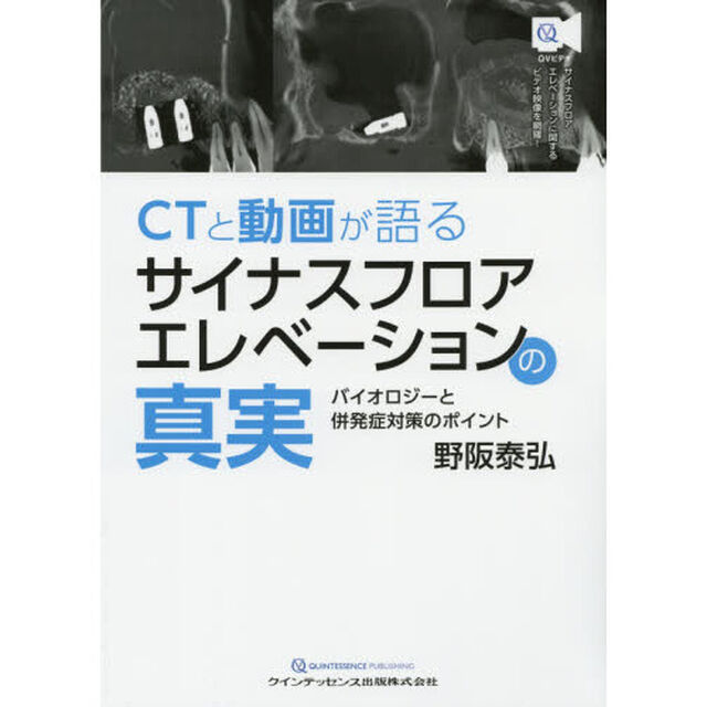 ＣＴと動画が語るサイナスフロアエレベーションの真実　バイオロジーと併発症対策のポイント