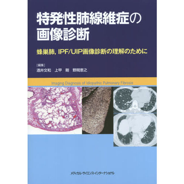 特発性肺線維症の画像診断　蜂巣肺，ＩＰＦ／ＵＩＰ画像診断の理解のために