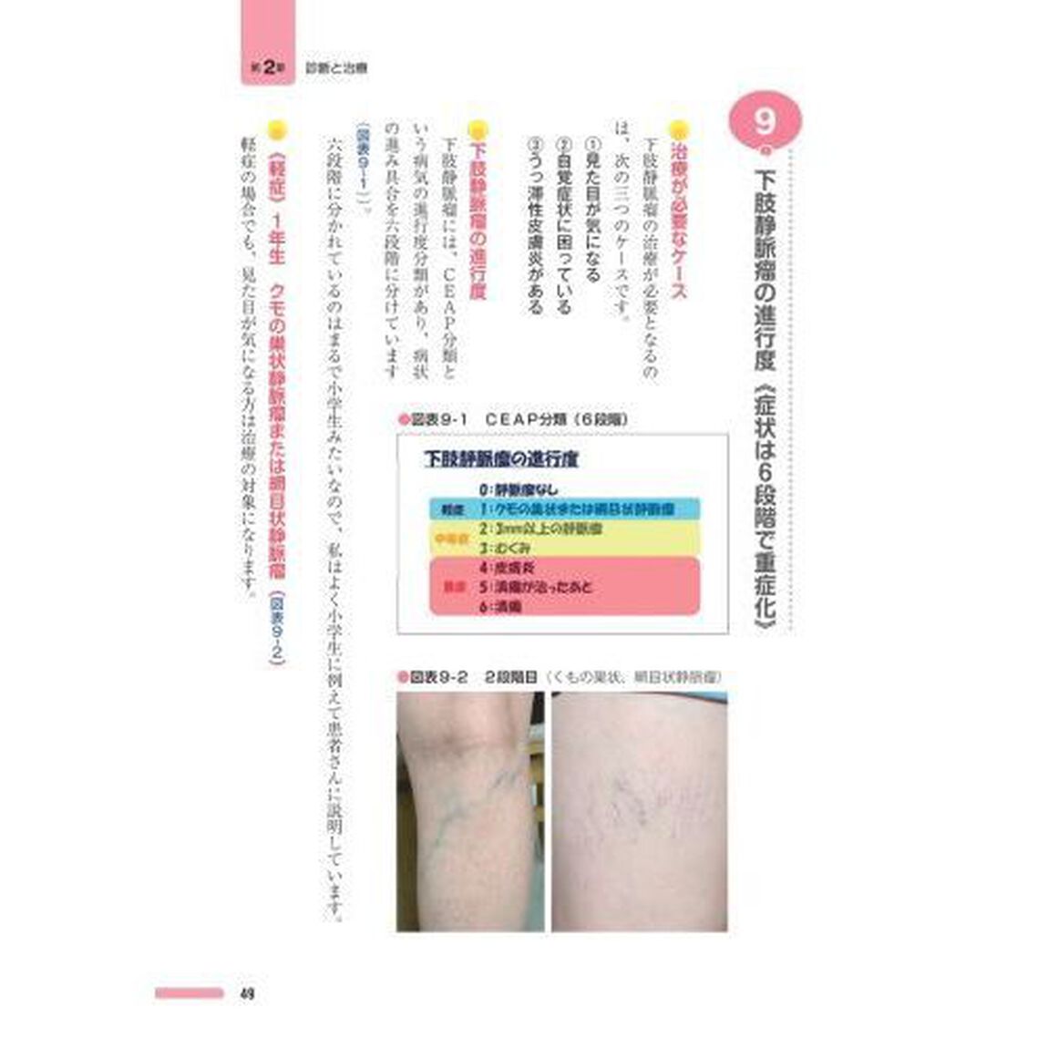 専門医が教える世界一わかりやすい下肢静脈瘤の治療と予防　見過ごしてはいけない脚の&ldquo;むくみ&rdquo;と&ldquo;だるさ&rdquo;