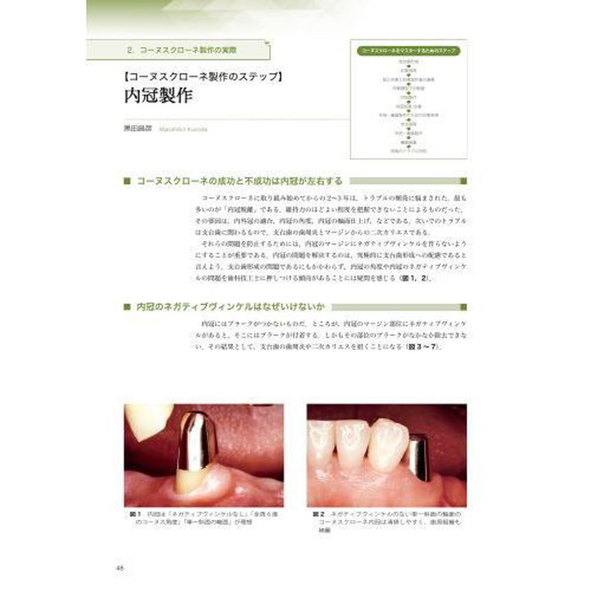 検証コーヌスクローネ　長期経過症例と臨床統計からの再評価