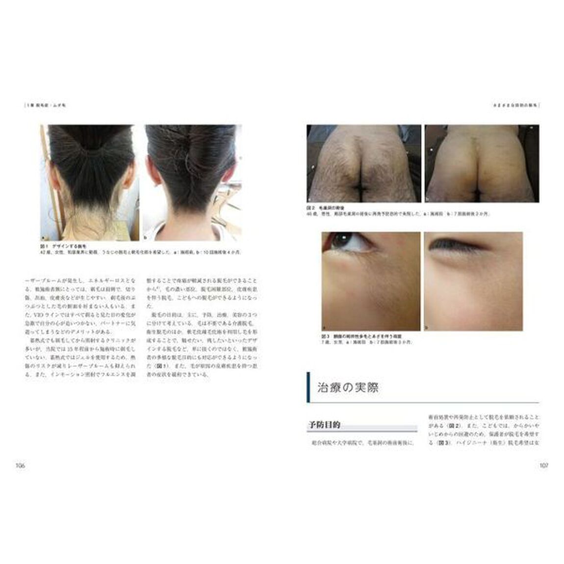 最新美容皮膚科学大系　５「脱毛・にきびの治療　美容皮膚科オールラウンド」