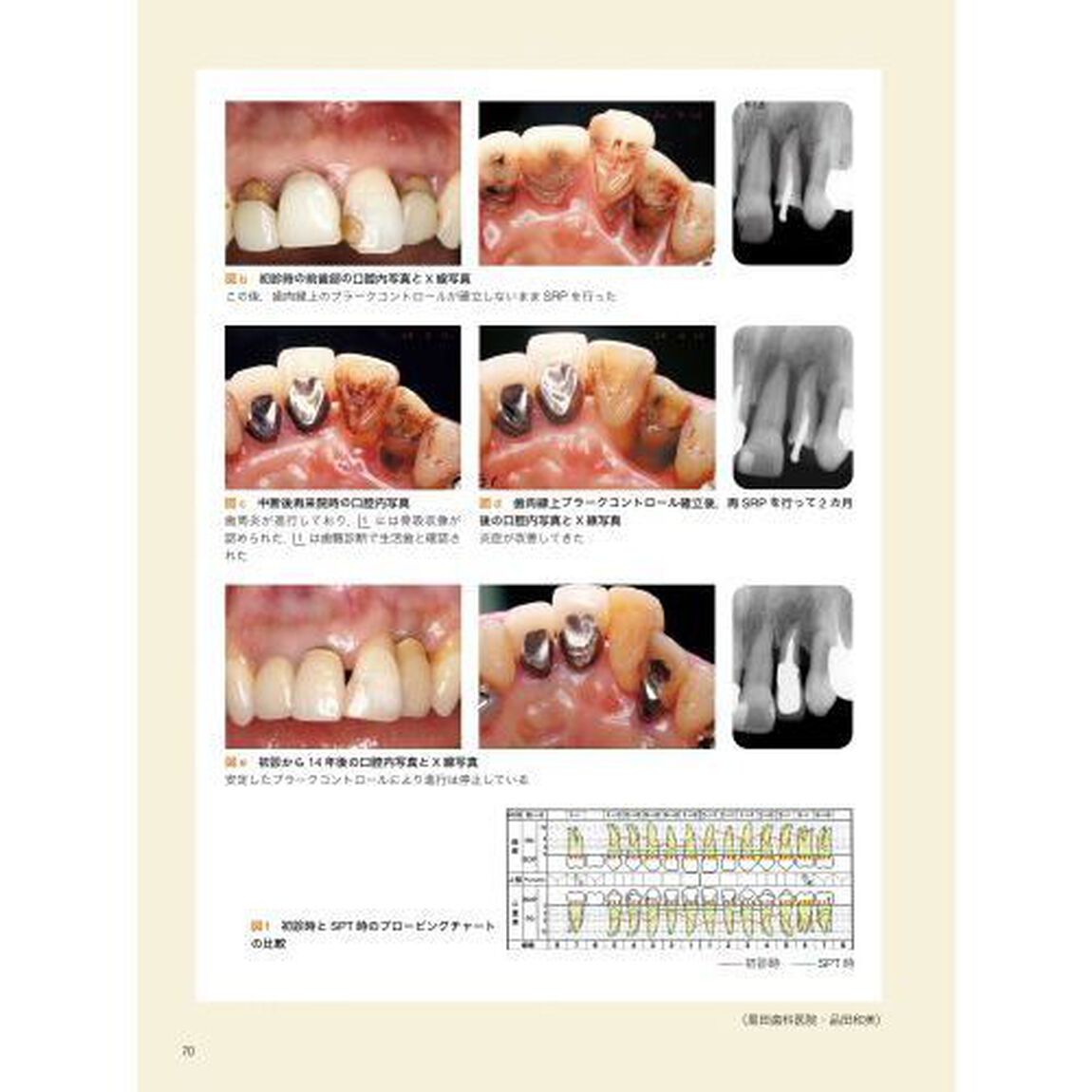 考える歯科衛生士のための歯周治療レッスンブック「新版」