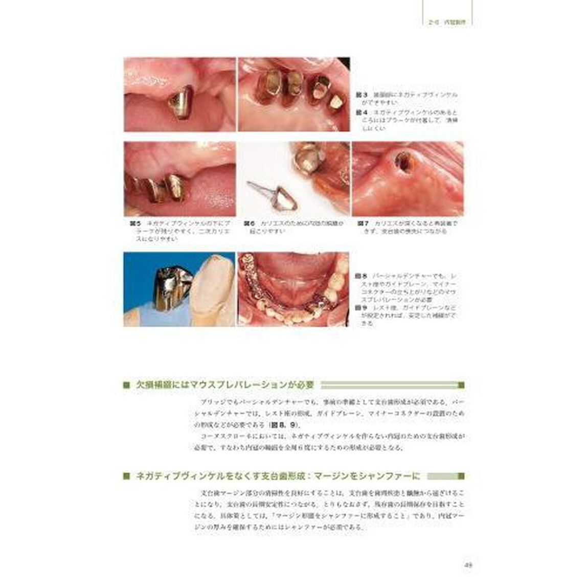 検証コーヌスクローネ　長期経過症例と臨床統計からの再評価