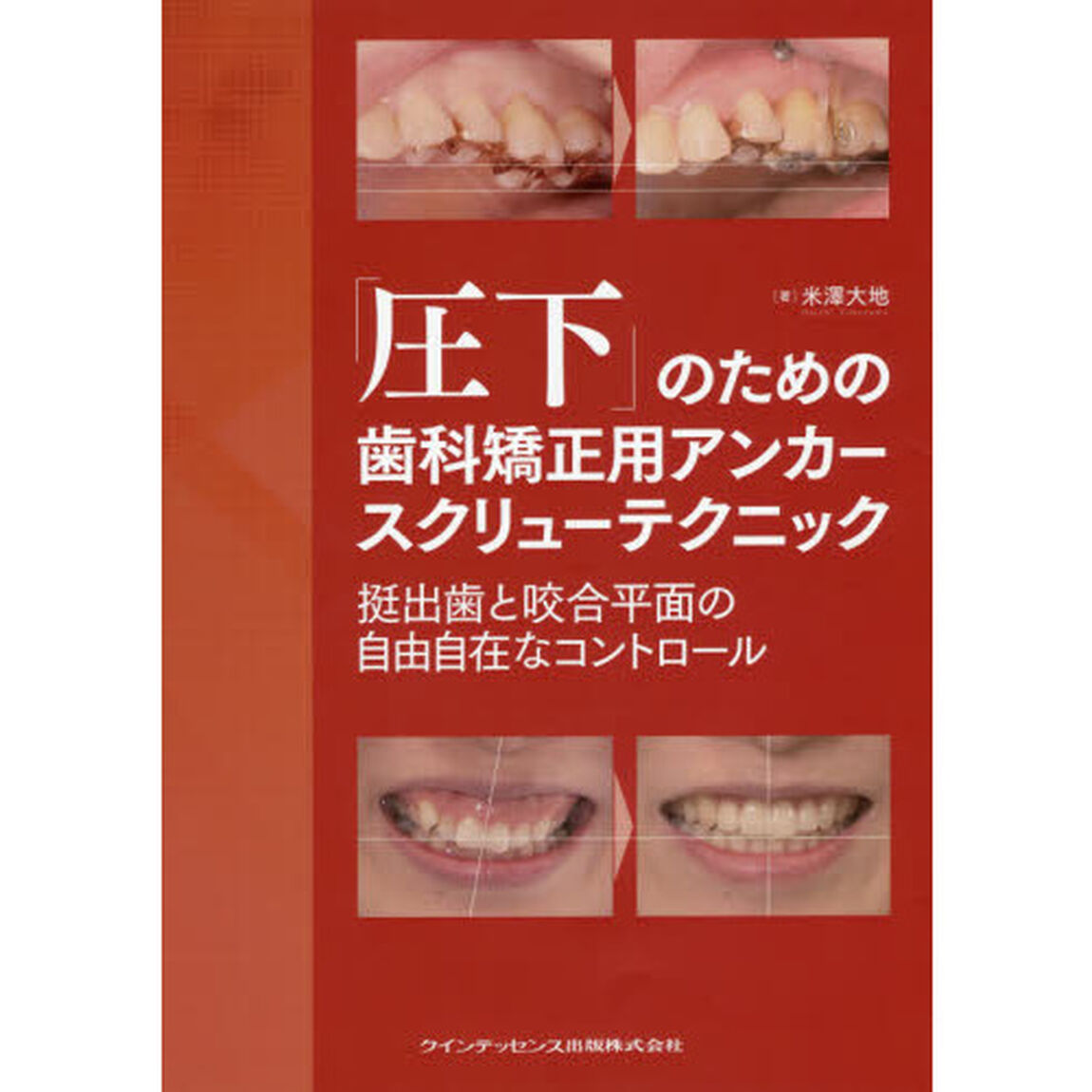 「圧下」のための歯科矯正用アンカースクリューテクニック　挺出歯と咬合平面の自由自在なコントロール