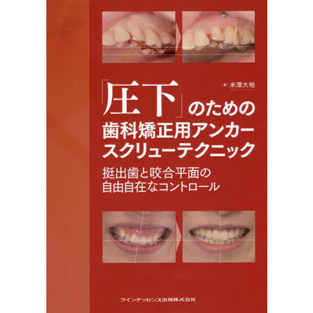 「圧下」のための歯科矯正用アンカースクリューテクニック　挺出歯と咬合平面の自由自在なコントロール