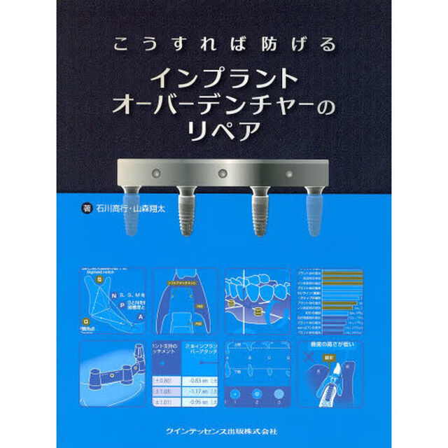 こうすれば防げるインプラントオーバーデンチャーのリペア