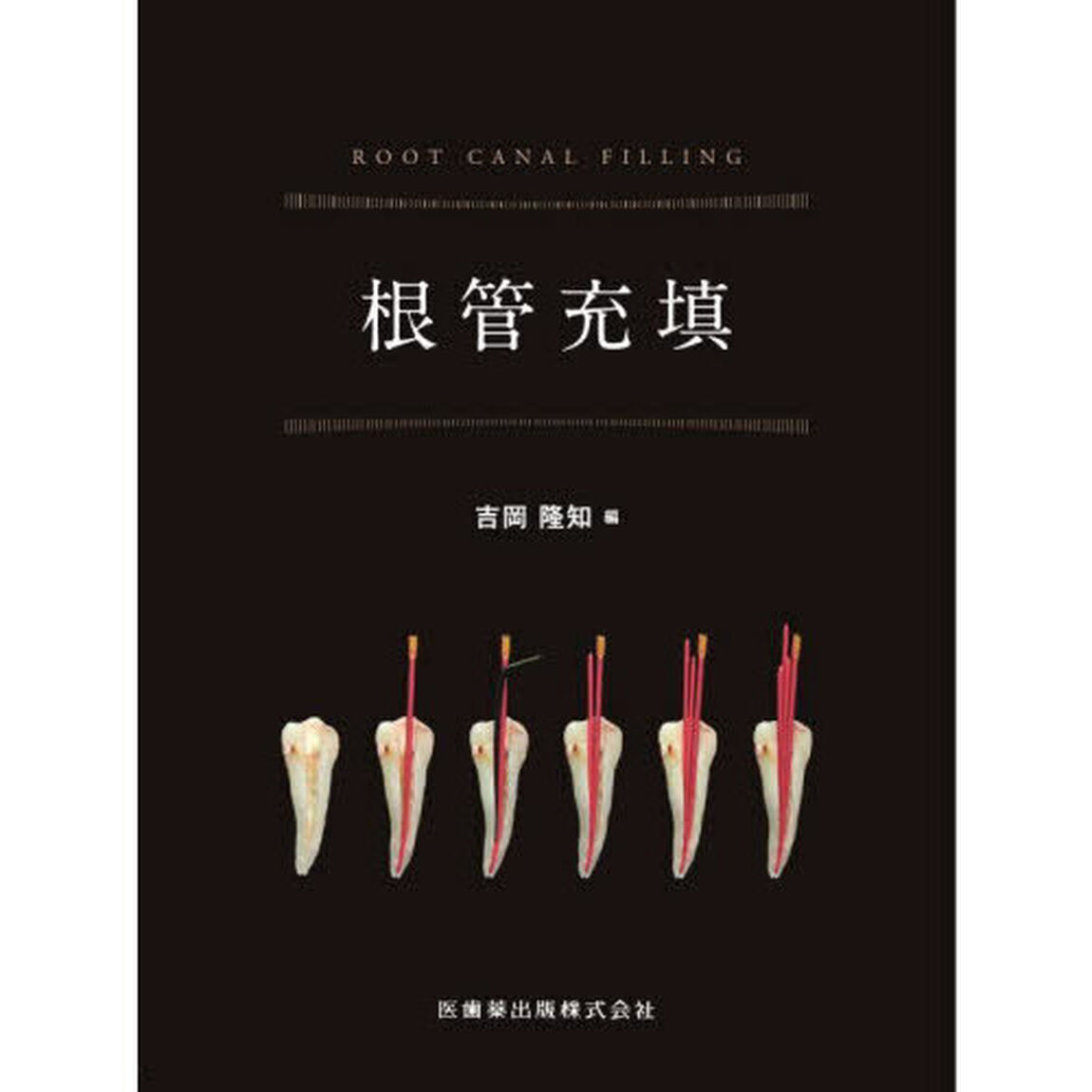 根管充填