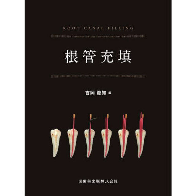 根管充填
