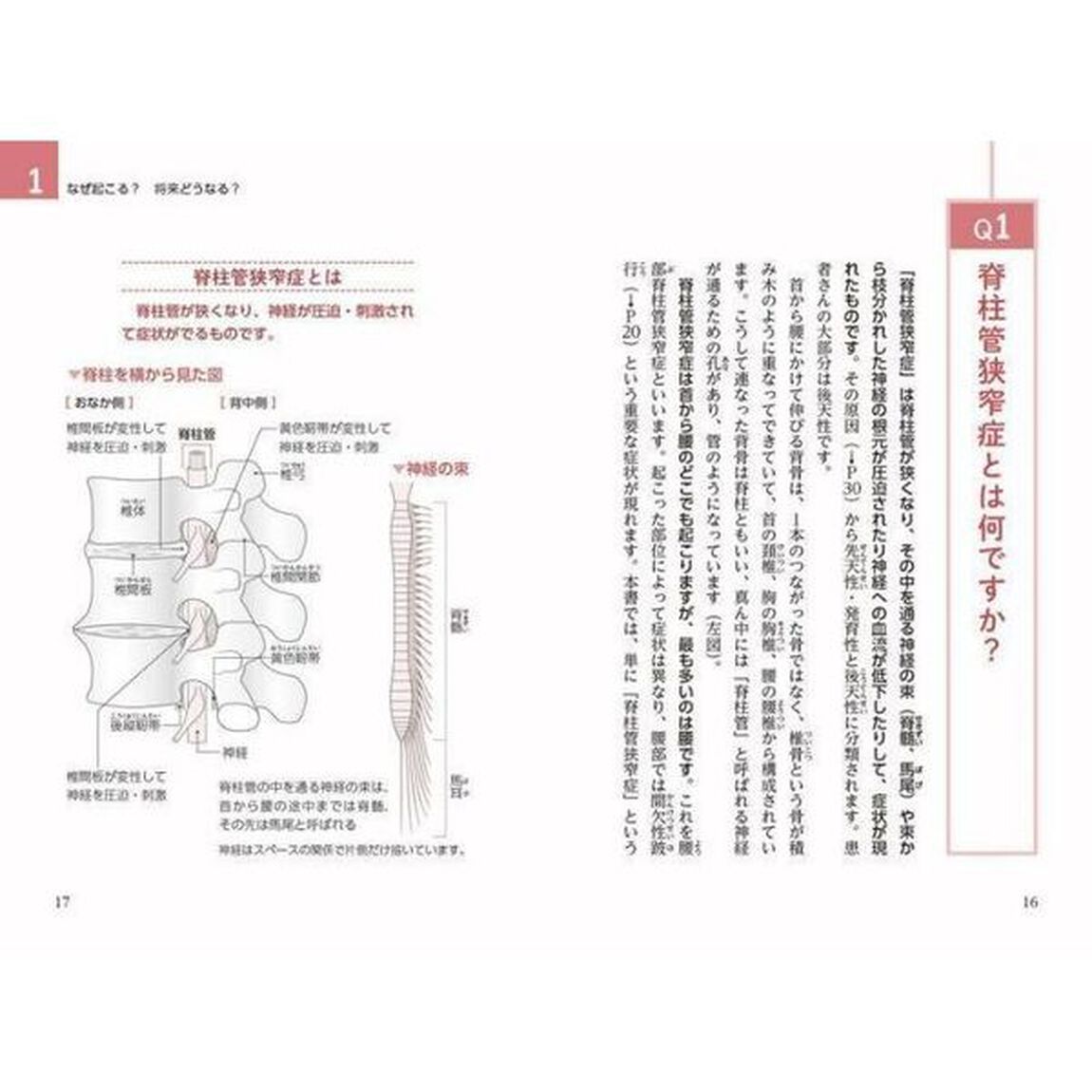 脊柱管狭窄症治療大全