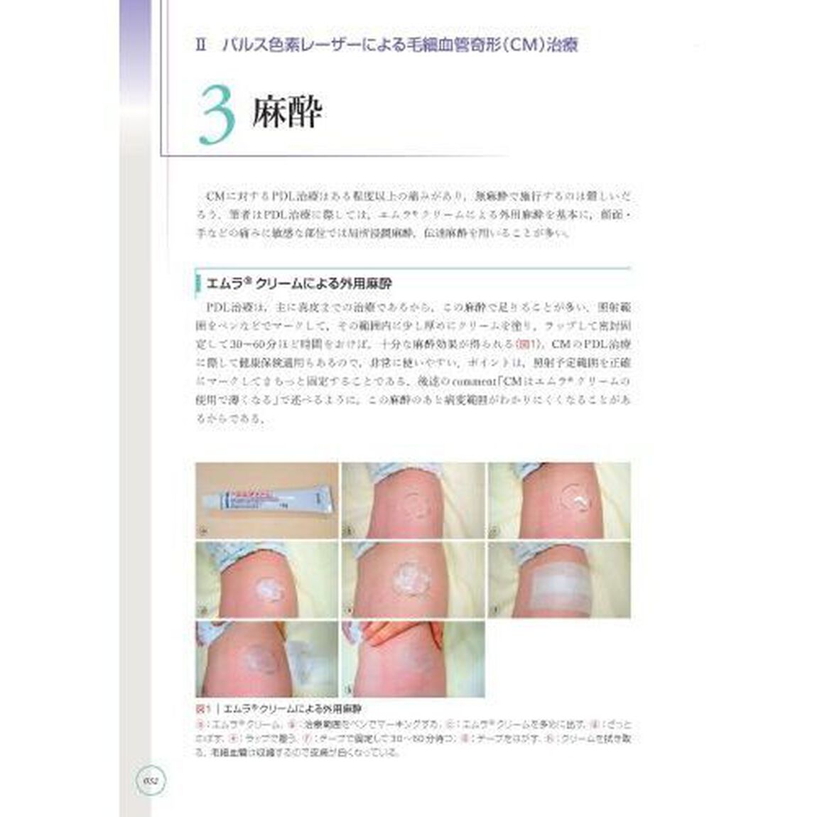 パルス色素レーザー治療スプリーム　形成外科医・皮膚科医のために