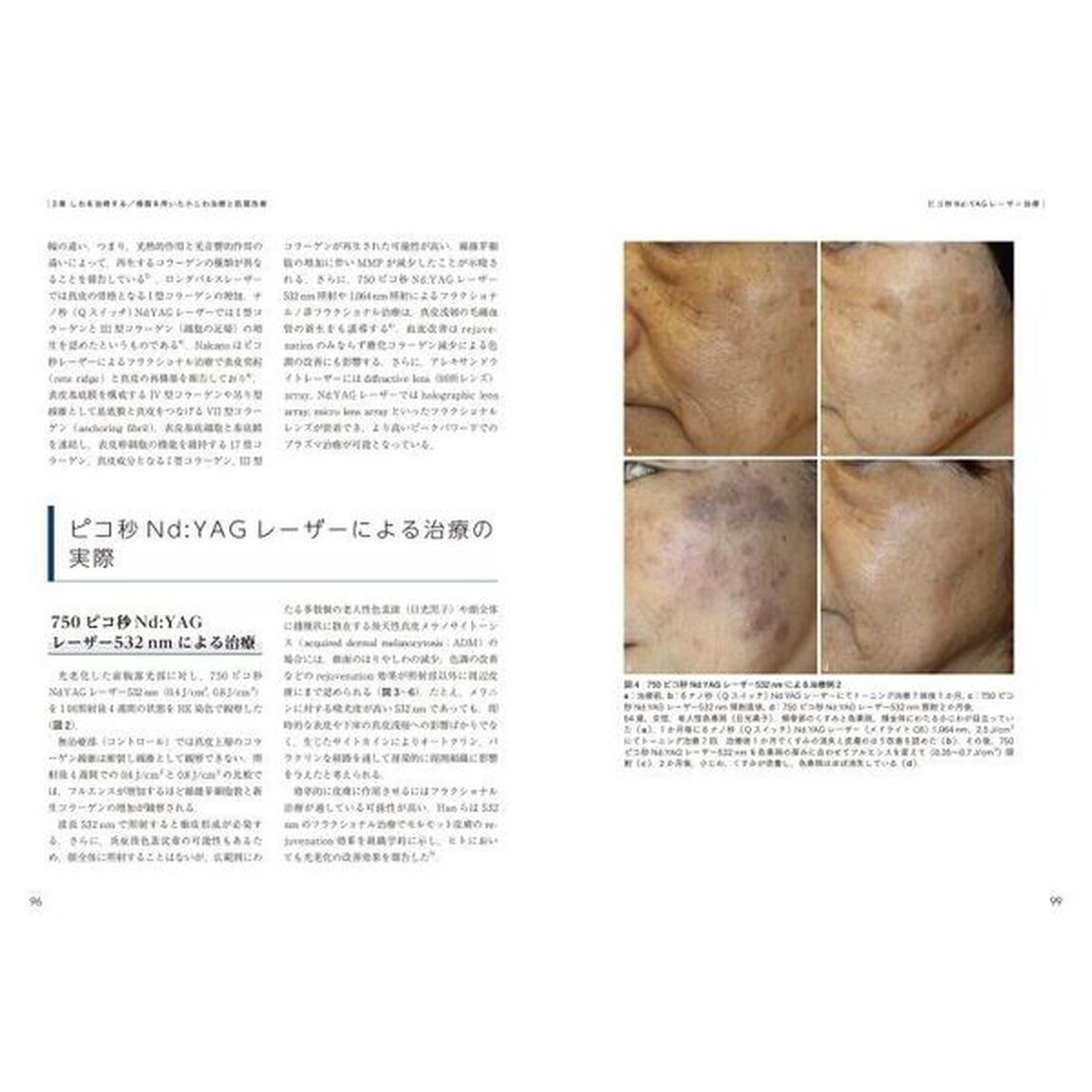 最新美容皮膚科学大系　４「しわ・たるみの治療」