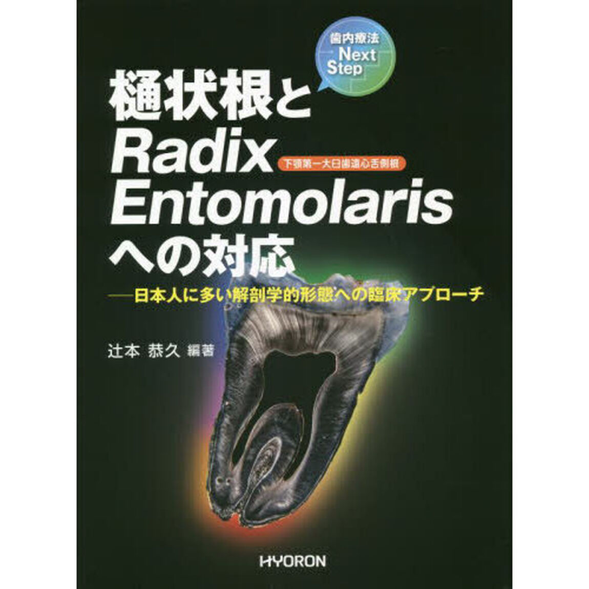 樋状根とＲａｄｉｘ　Ｅｎｔｏｍｏｌａｒｉｓへの対応　日本人に多い解剖学的形態への臨床アプローチ
