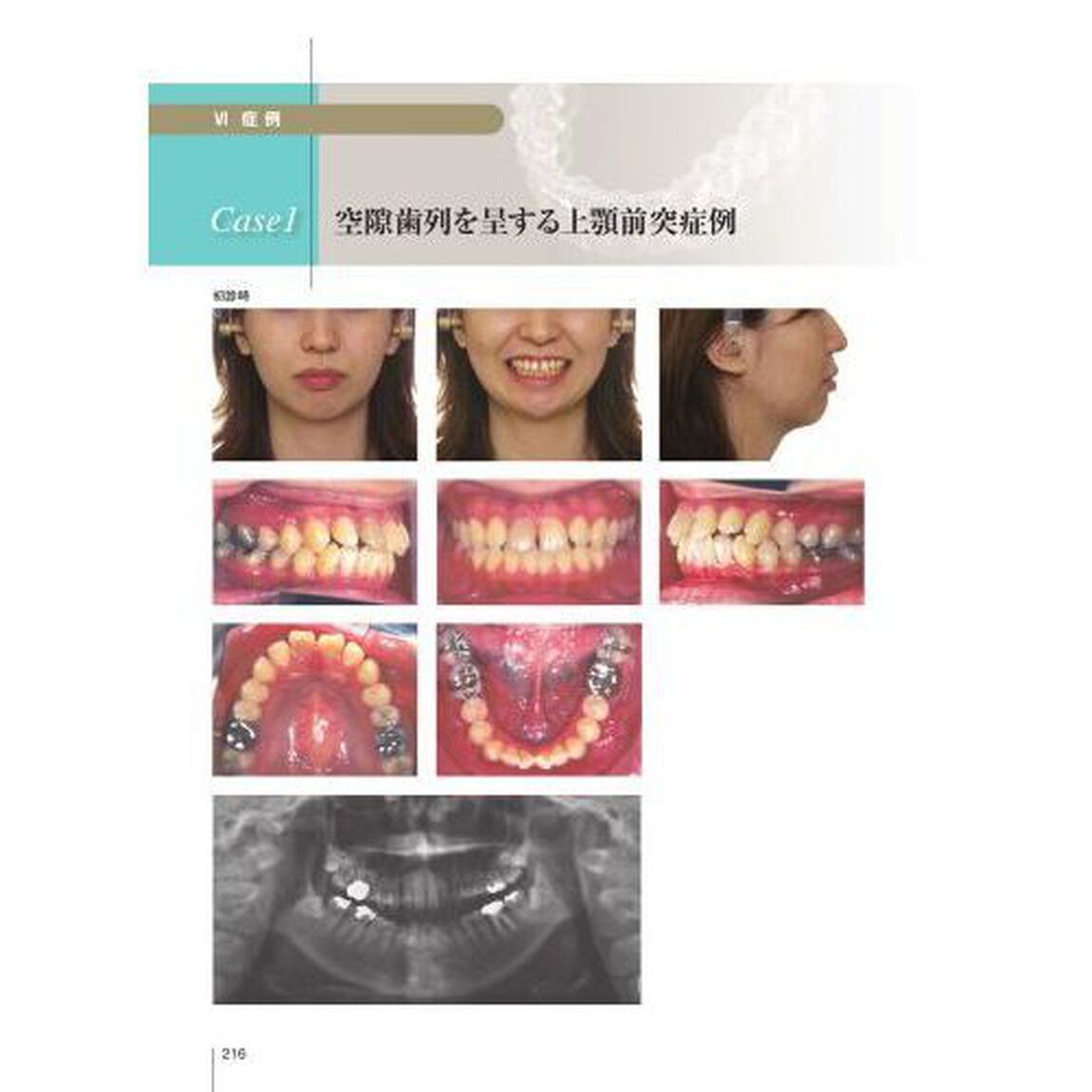 顎顔面のバイオメカニクスとアライナー矯正　バイオメカニクス矯正診断学　コンピュータ支援矯正学　アライナー矯正学