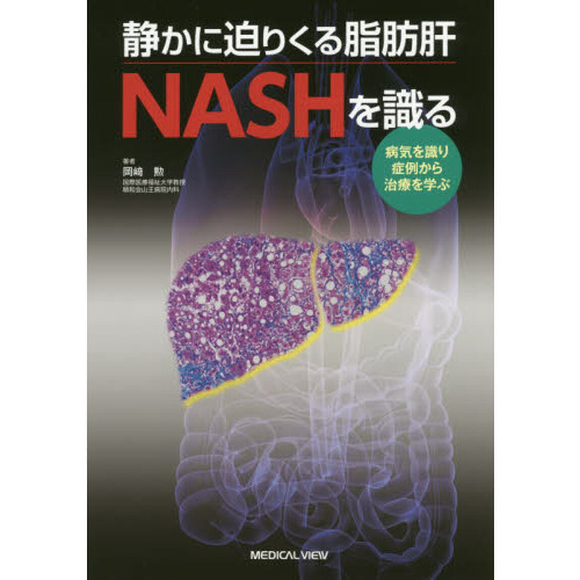 静かに迫りくる脂肪肝ＮＡＳＨを識る　病気を識り症例から治療を学ぶ