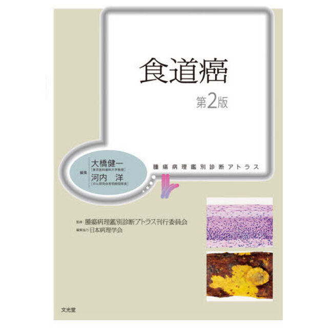 食道癌「第２版」