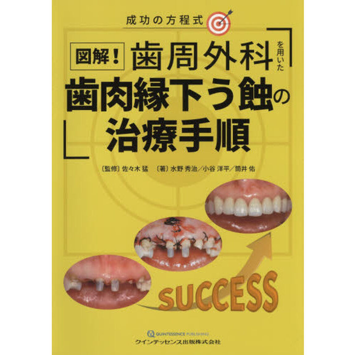 図解！歯周外科を用いた歯肉縁下う蝕の治療手順　成功の方程式
