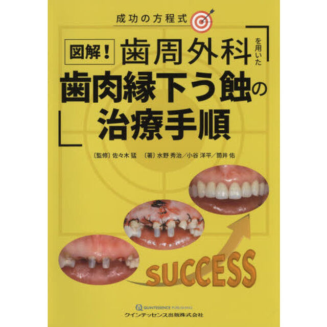 図解！歯周外科を用いた歯肉縁下う蝕の治療手順　成功の方程式