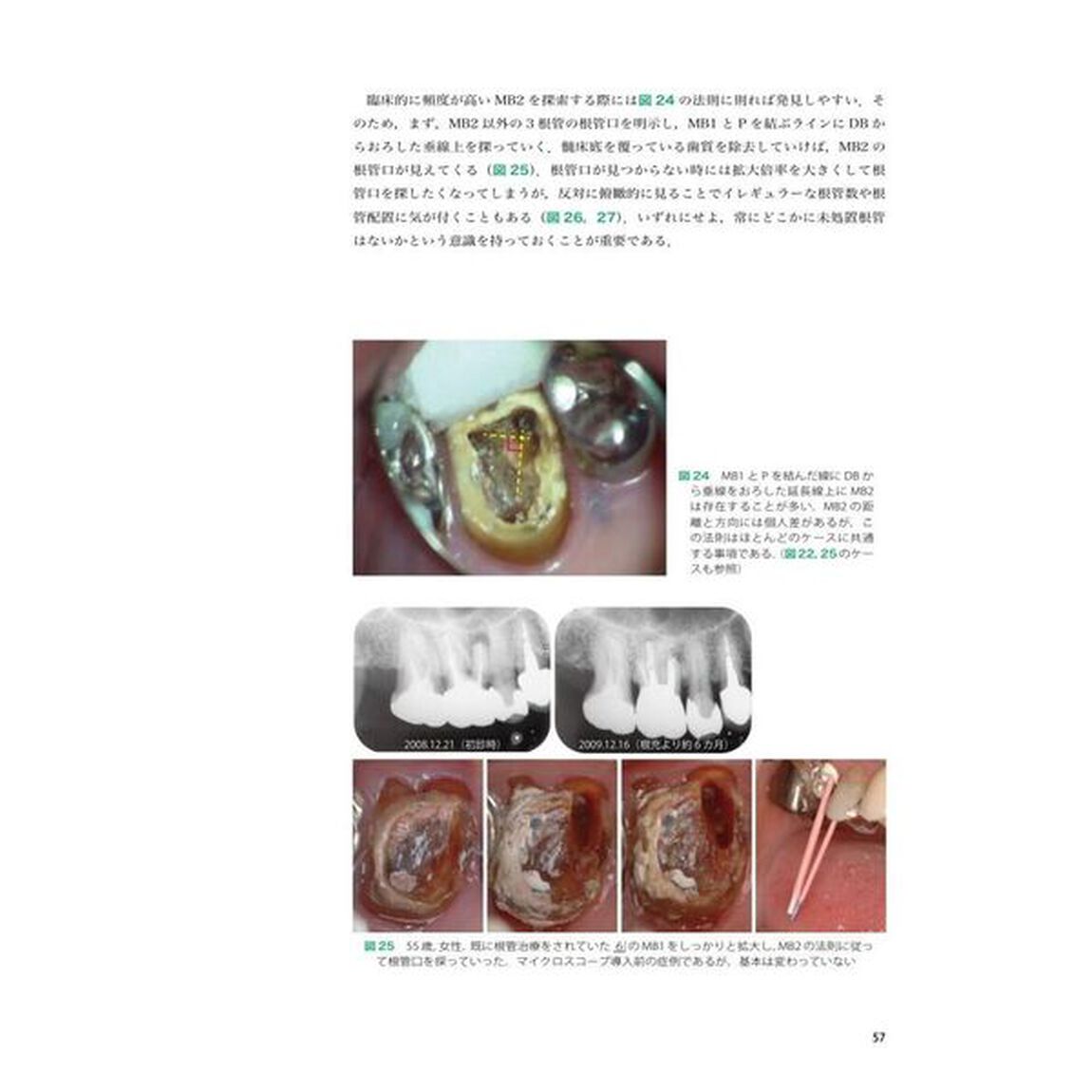 チェックリストで見直す上達必至の歯内療法
