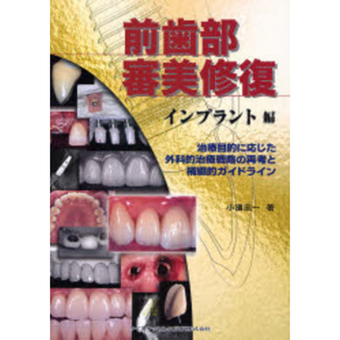 前歯部審美修復　インプラント編「治療目的に応じた外科的治療戦略の再考と補綴的ガイドライン」