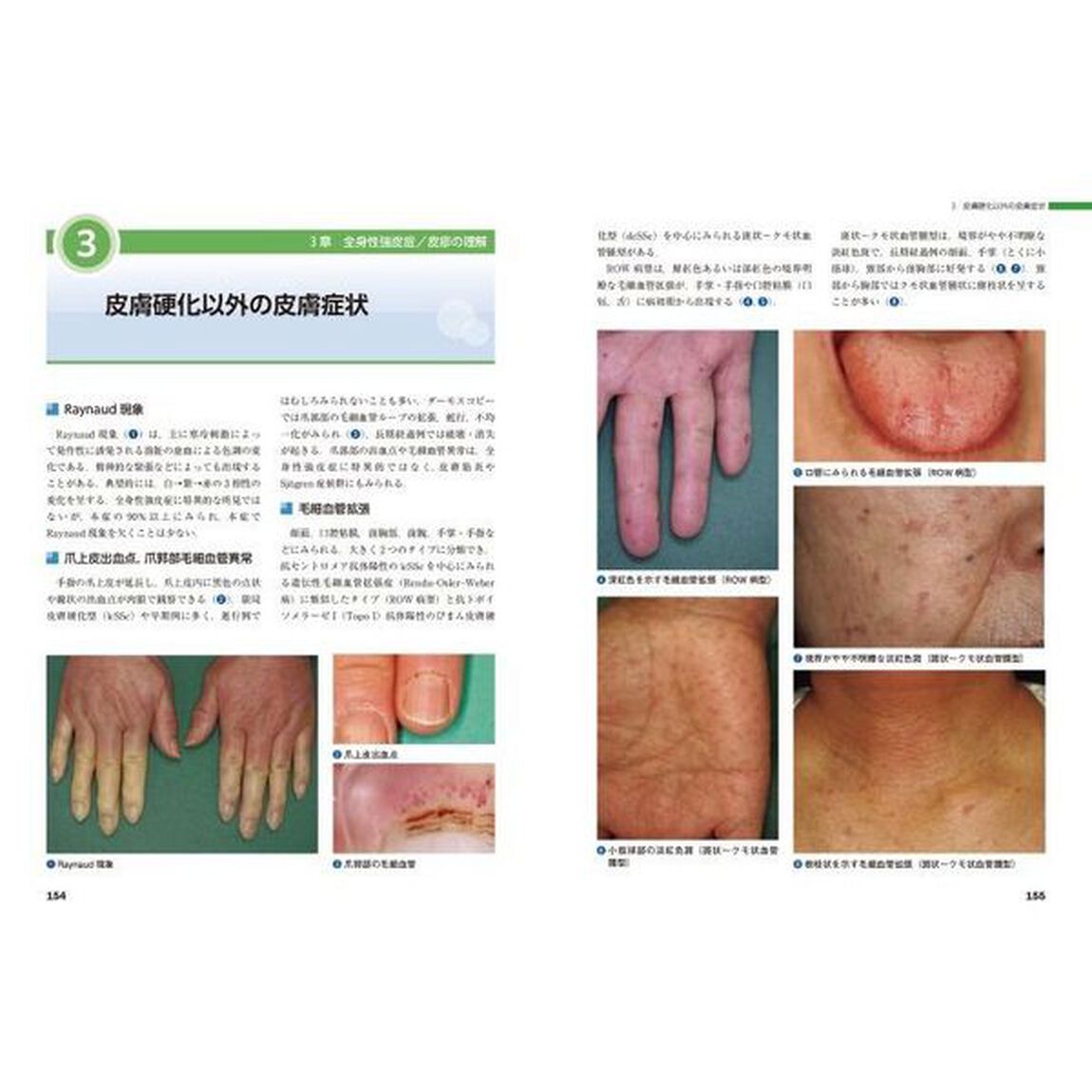 皮膚科膠原病　皮診から全身を診る