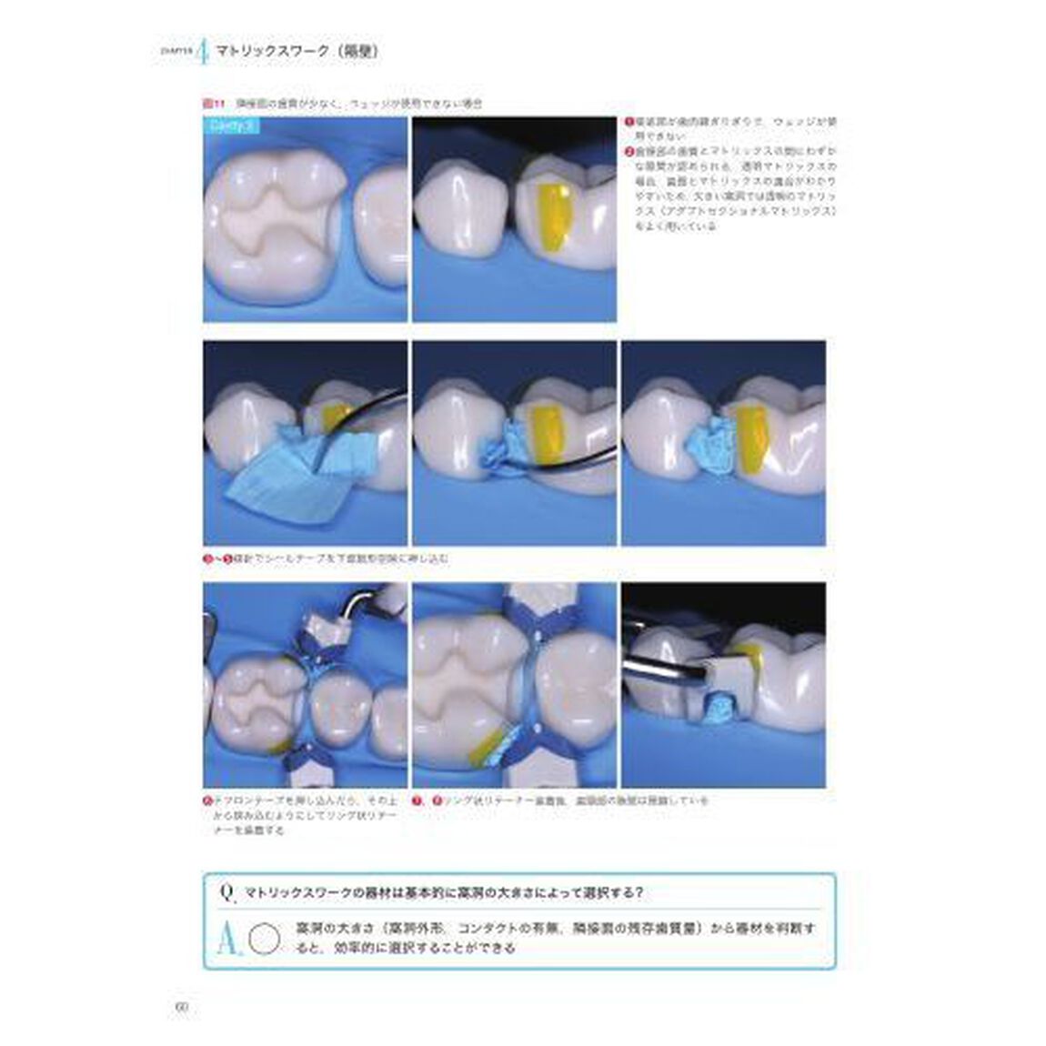 手に取るようにわかるコンポジットレジン修復のメソッド
