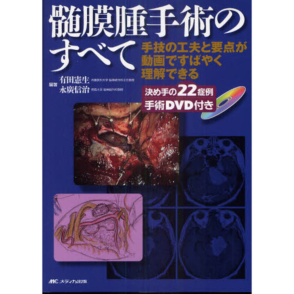 髄膜腫手術のすべて　手技の工夫と要点が動画ですばやく理解できる　決め手の２２症例手術ＤＶＤ付き