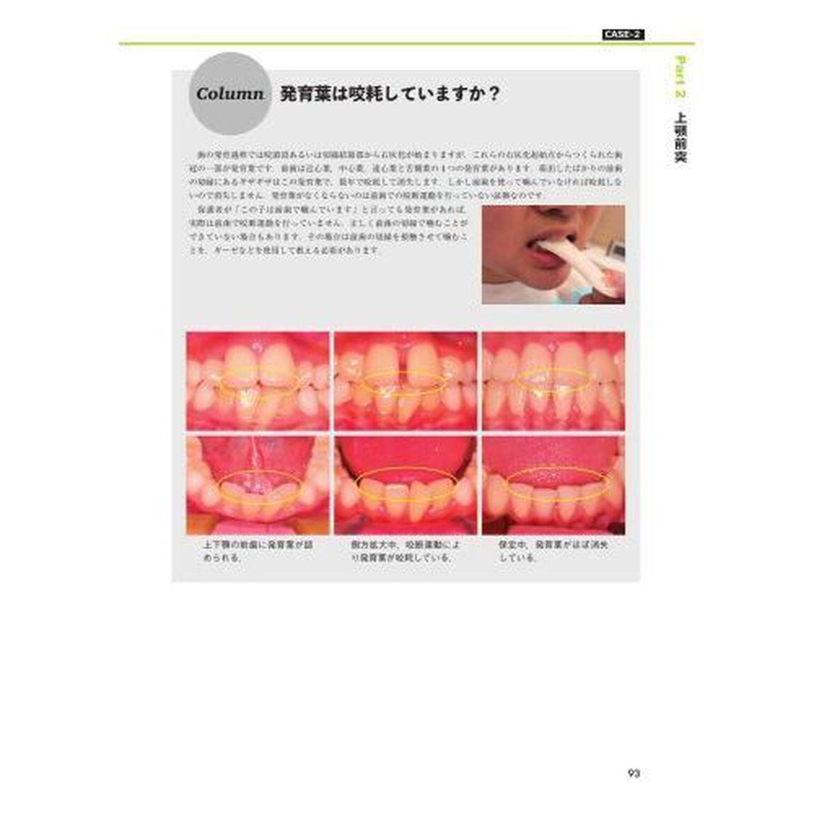 臨床家のための床矯正治療　不正咬合別のアプローチ　１「叢生・上顎前突・過蓋咬合」