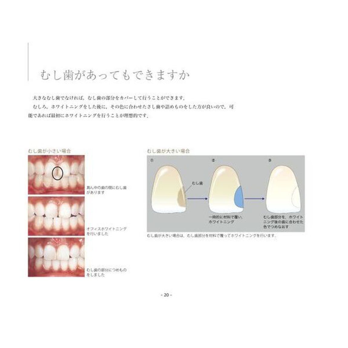 笑顔が変わるホワイトニング　新装版