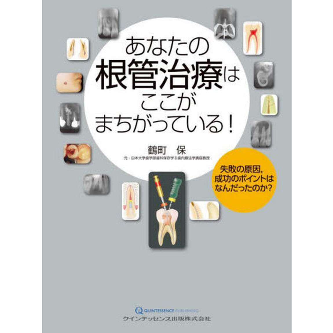 あなたの根管治療はここがまちがっている！　失敗の原因，成功のポイントはなんだったのか？