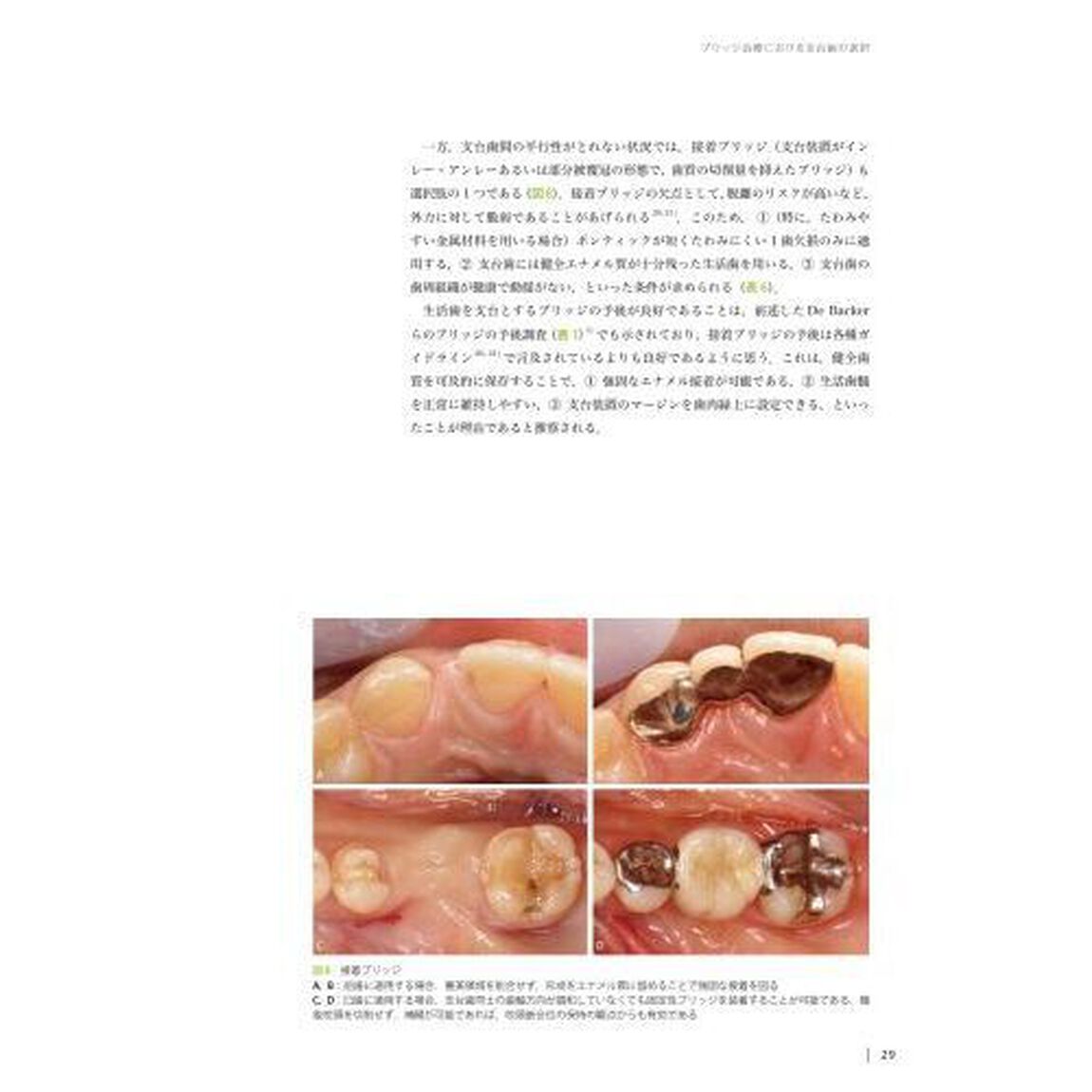ブリッジ・部分床義歯の支台歯選択