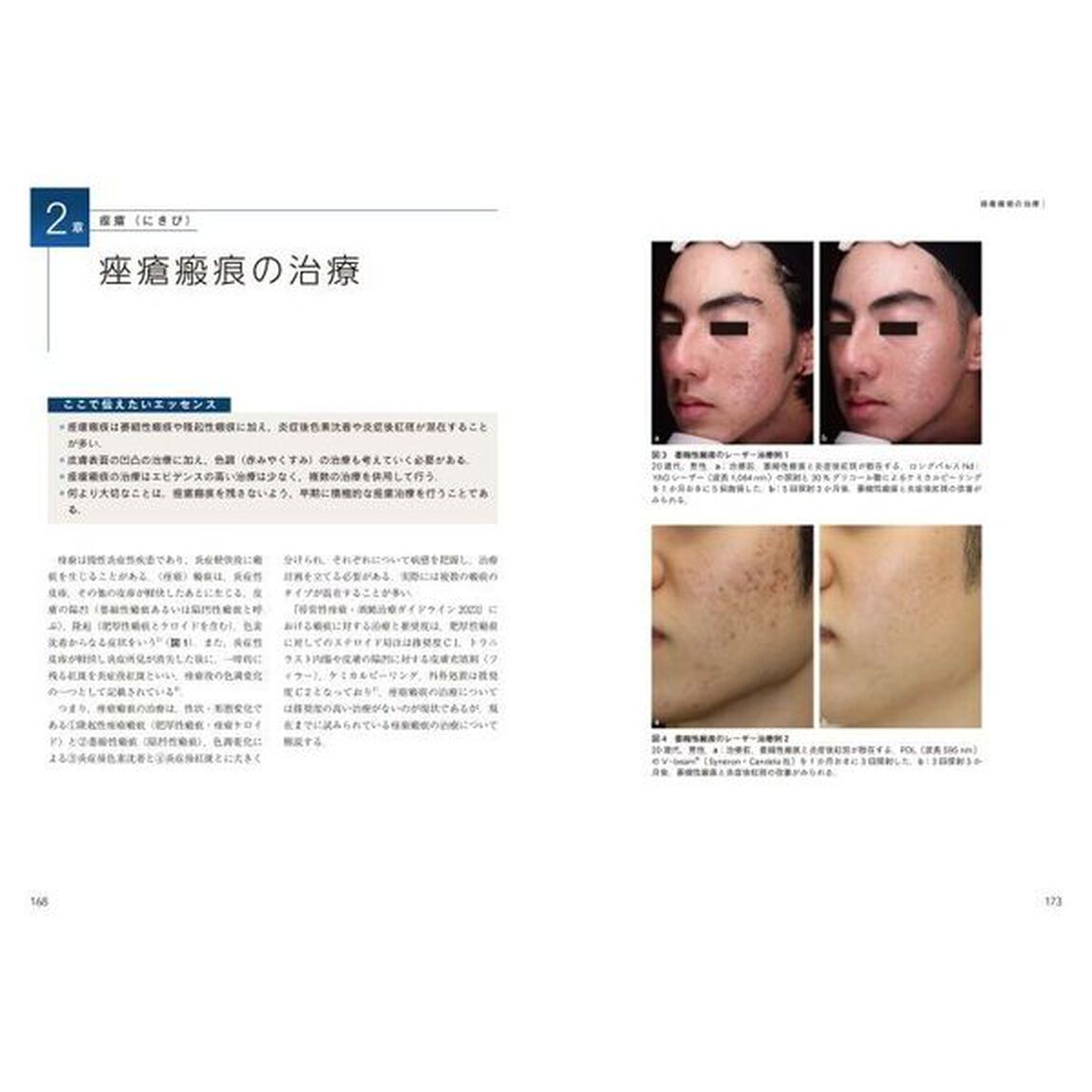 最新美容皮膚科学大系　５「脱毛・にきびの治療　美容皮膚科オールラウンド」