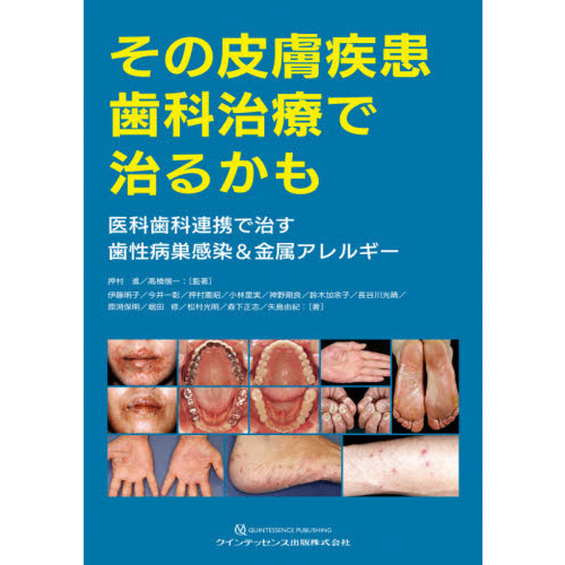その皮膚疾患歯科治療で治るかも　医科歯科連携で治す歯性病巣感染＆金属アレルギー