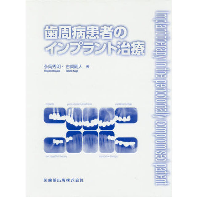 歯周病患者のインプラント治療