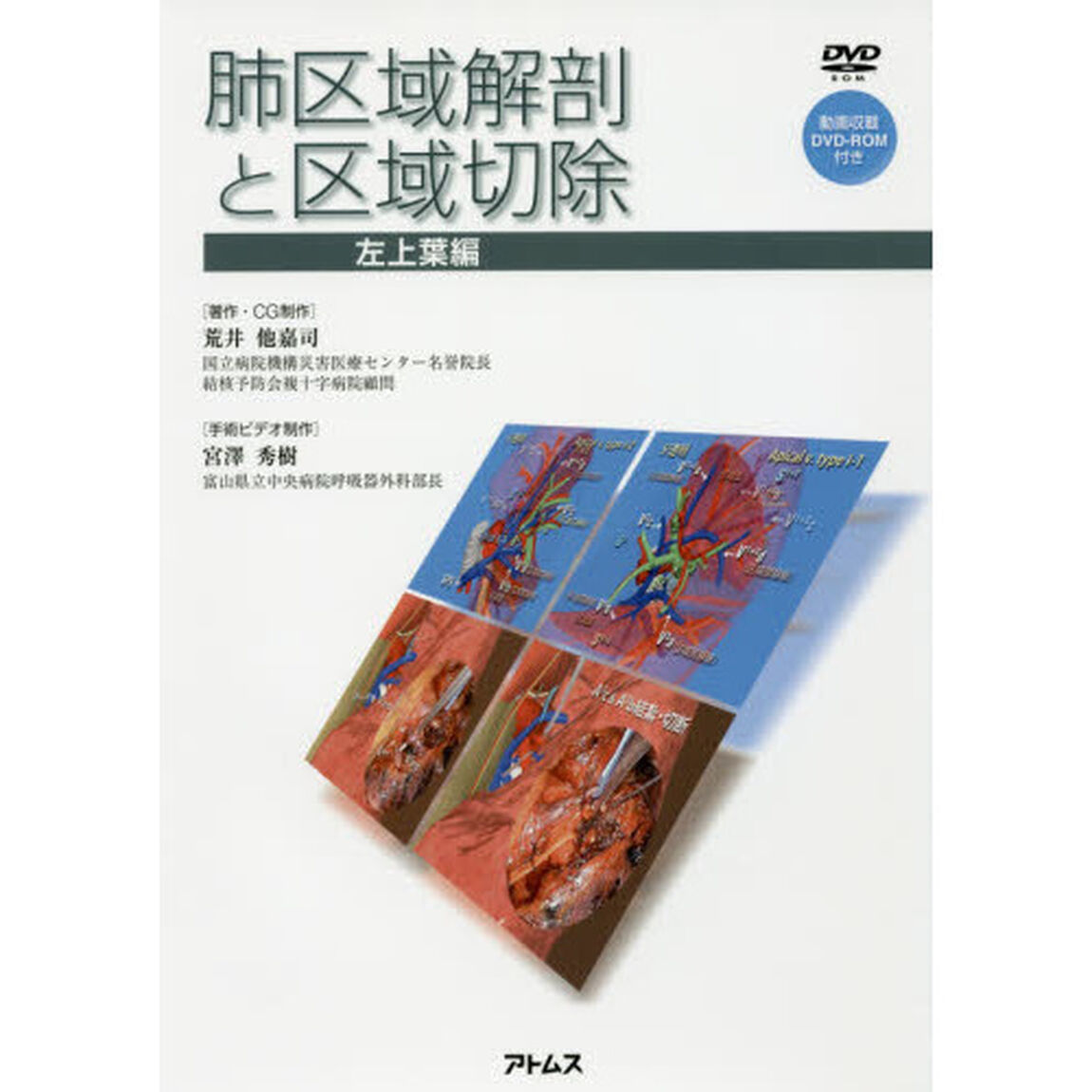 肺区域解剖と区域切除　左上葉編