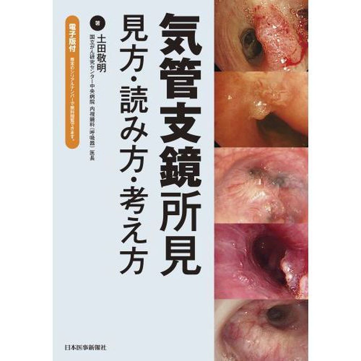 気管支鏡所見　見方・読み方・考え方
