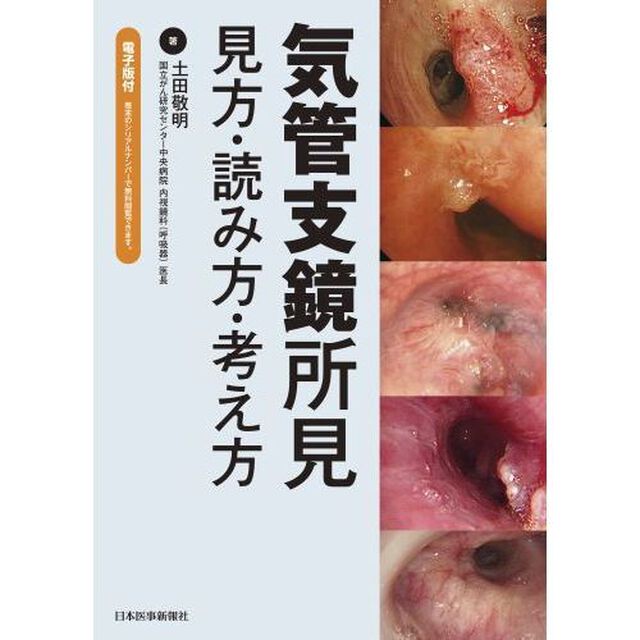 気管支鏡所見　見方・読み方・考え方
