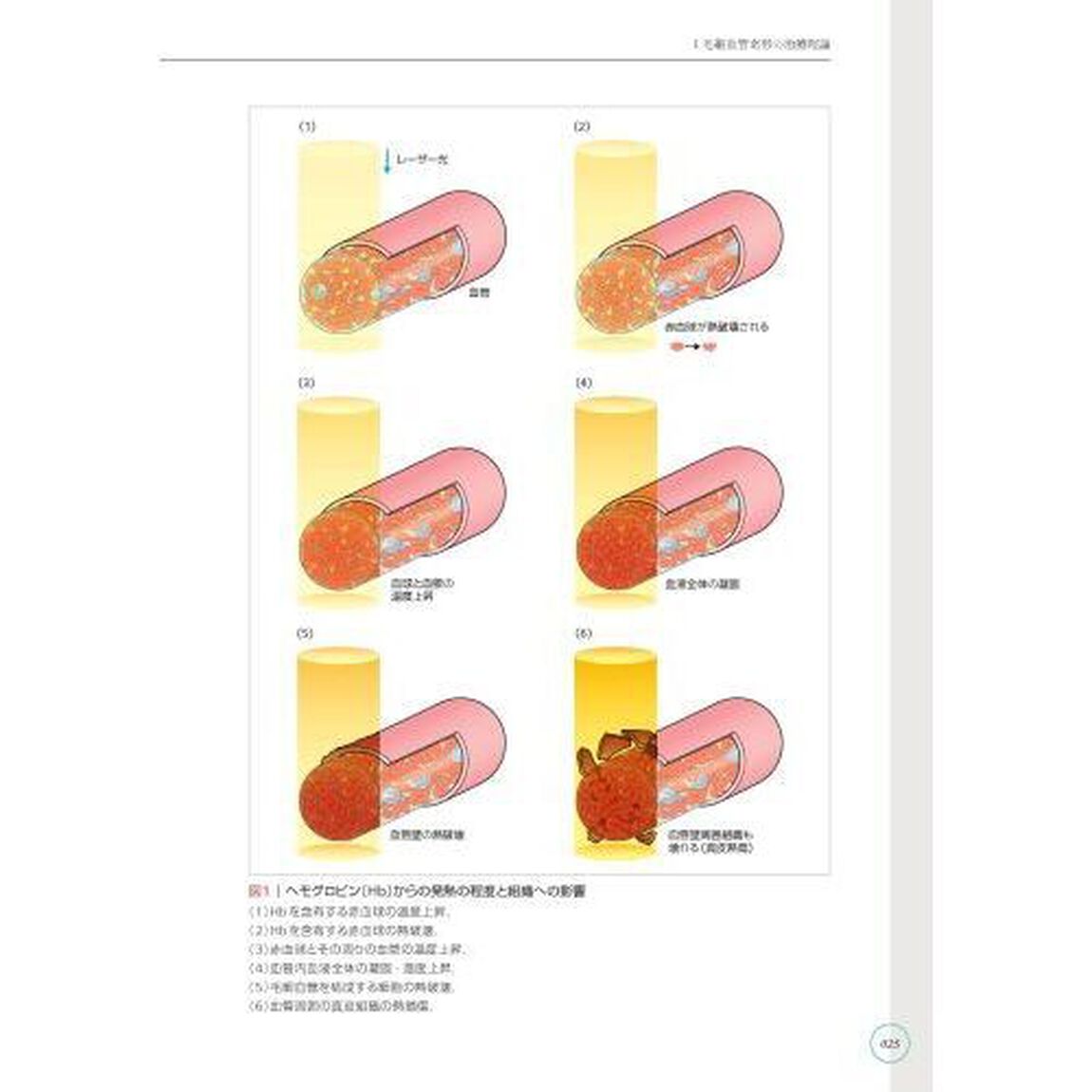 パルス色素レーザー治療スプリーム　形成外科医・皮膚科医のために