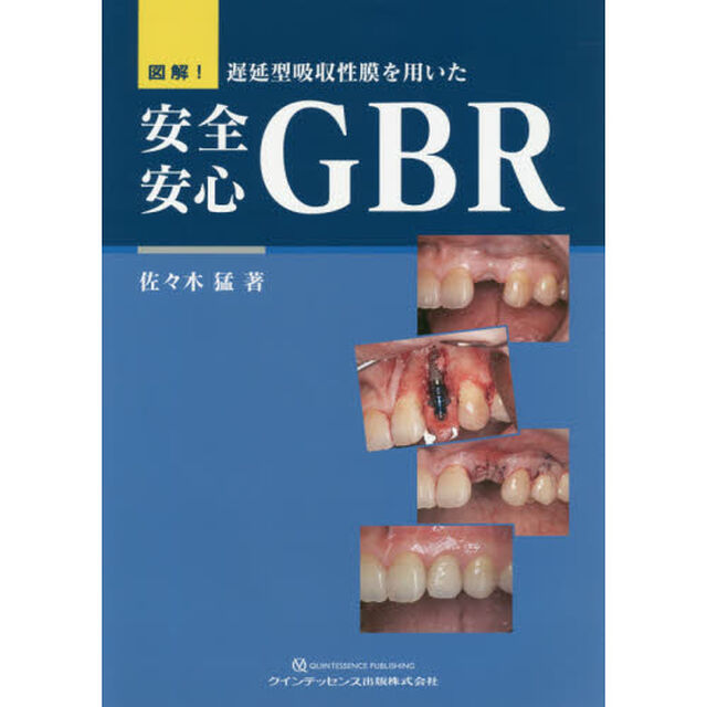 図解！遅延型吸収性膜を用いた安全安心ＧＢＲ