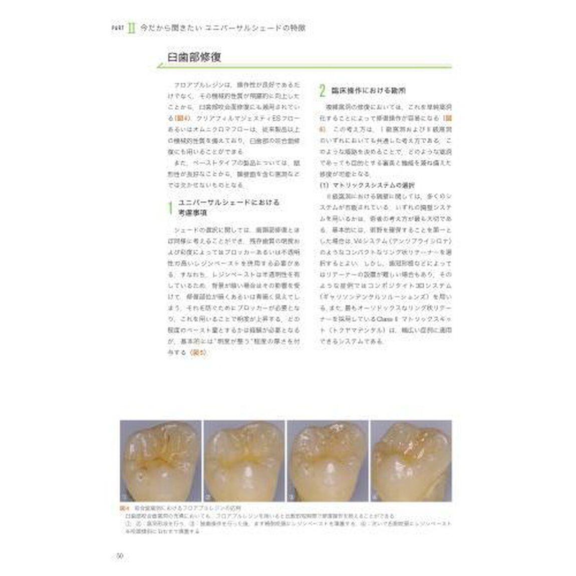 ユニバーサルシェードを使いこなす　シェード選択で迷わないコンポジットレジン修復