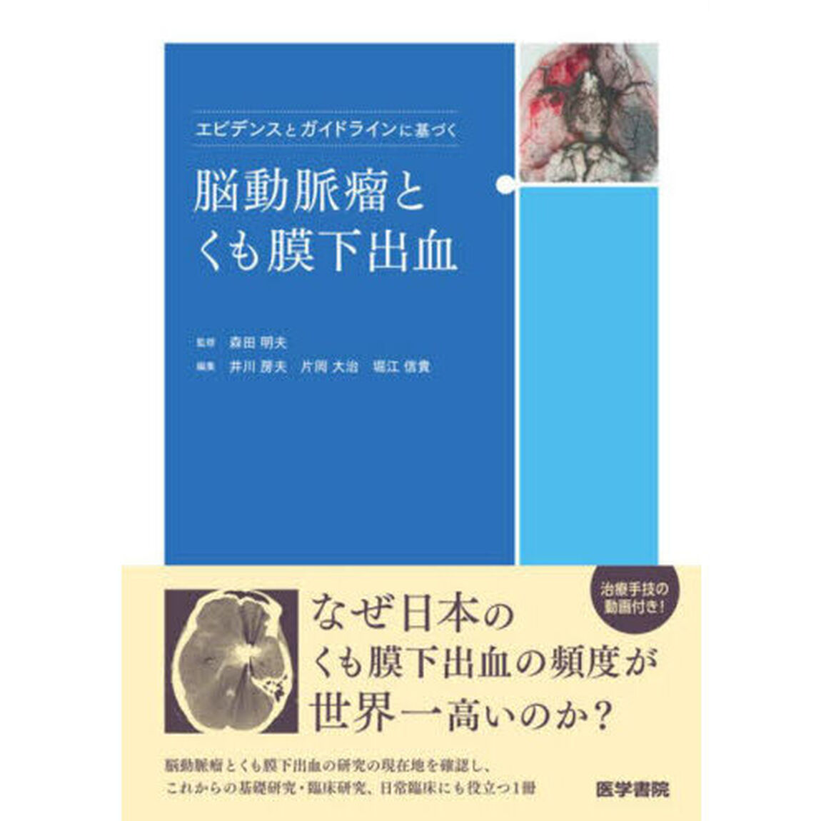 エビデンスとガイドラインに基づく脳動脈瘤とくも膜下出血