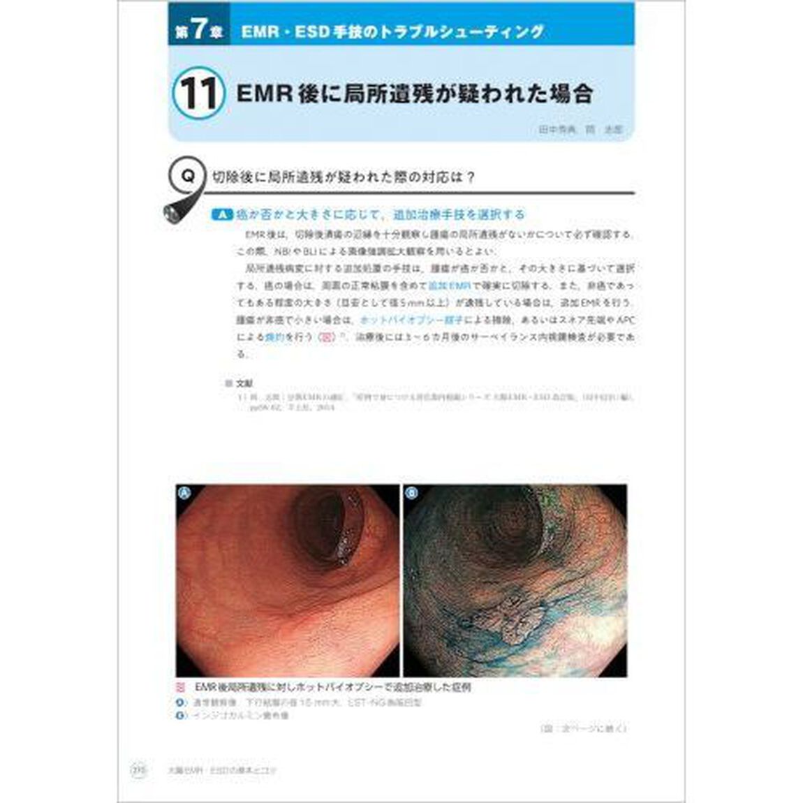 大腸ＥＭＲ・ＥＳＤの基本とコツ　エキスパートならではの治療手技・戦略を伝授