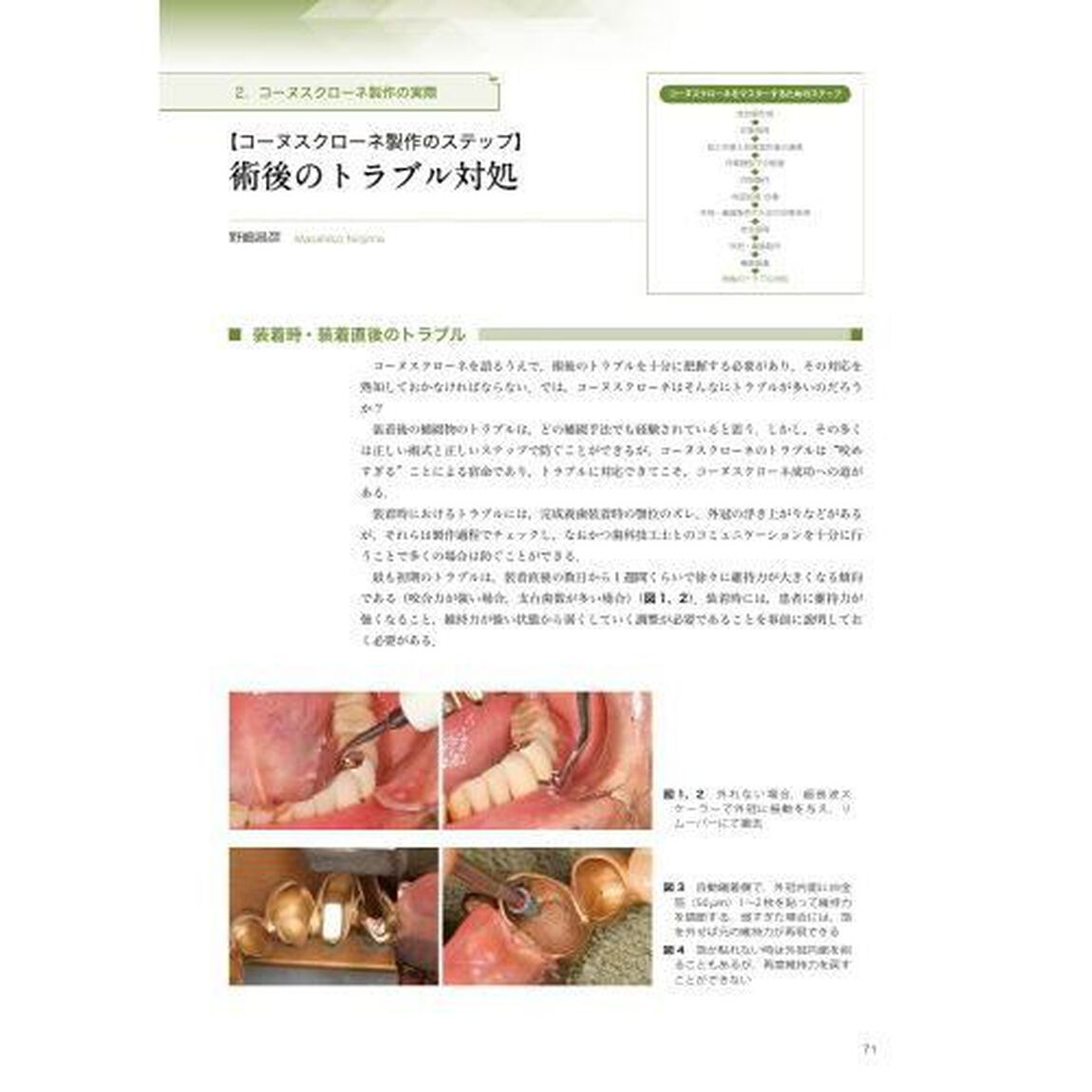 検証コーヌスクローネ　長期経過症例と臨床統計からの再評価